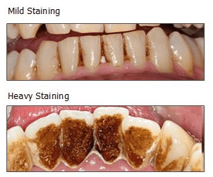 chewing tobacco stains on teeth Tips to Help Avoid Stained Teeth